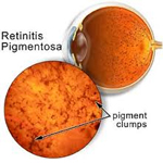 retinitis-pigmentosa